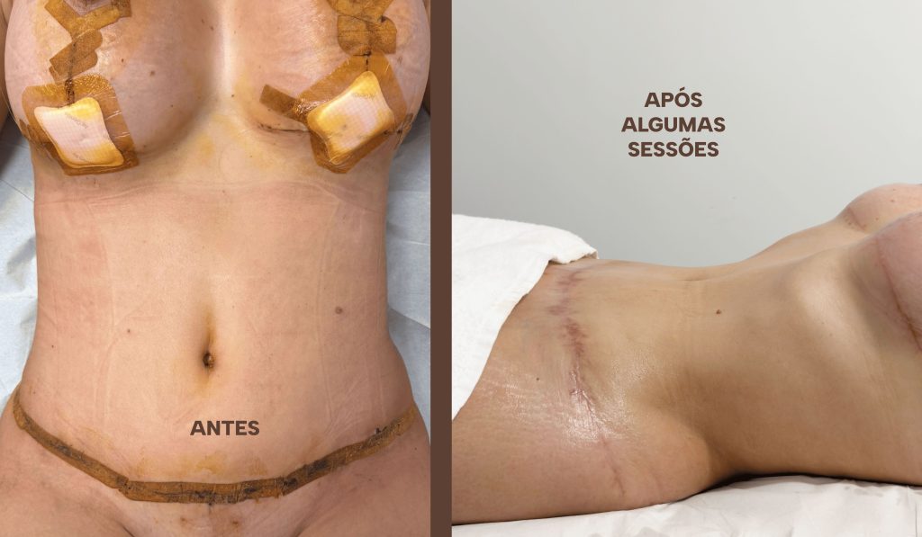 RESULTADOS RECUPERACAO POS OPERATORIO (1)-compressed