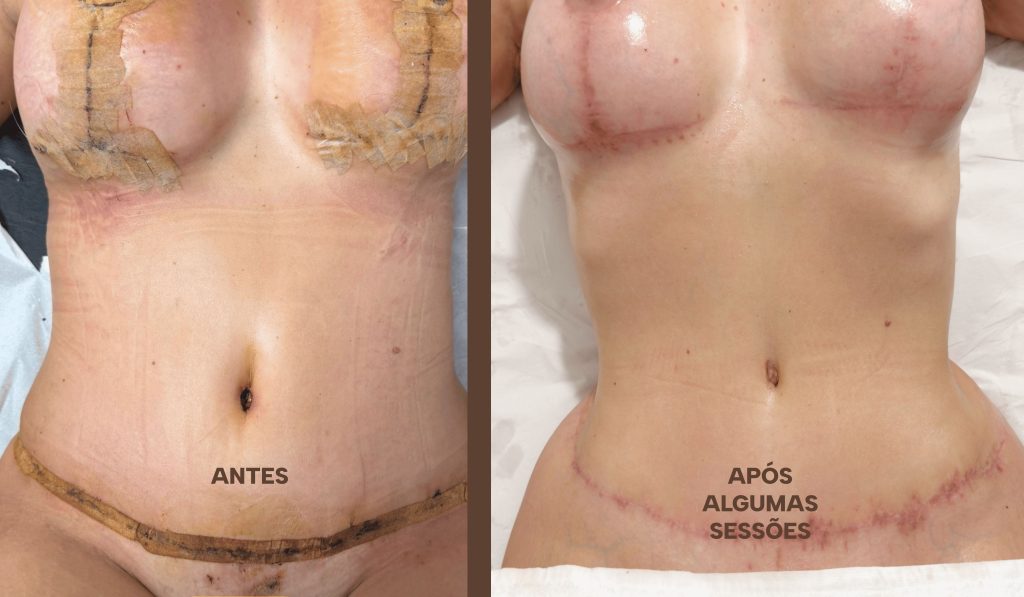 RESULTADOS RECUPERACAO POS OPERATORIO-compressed (1)