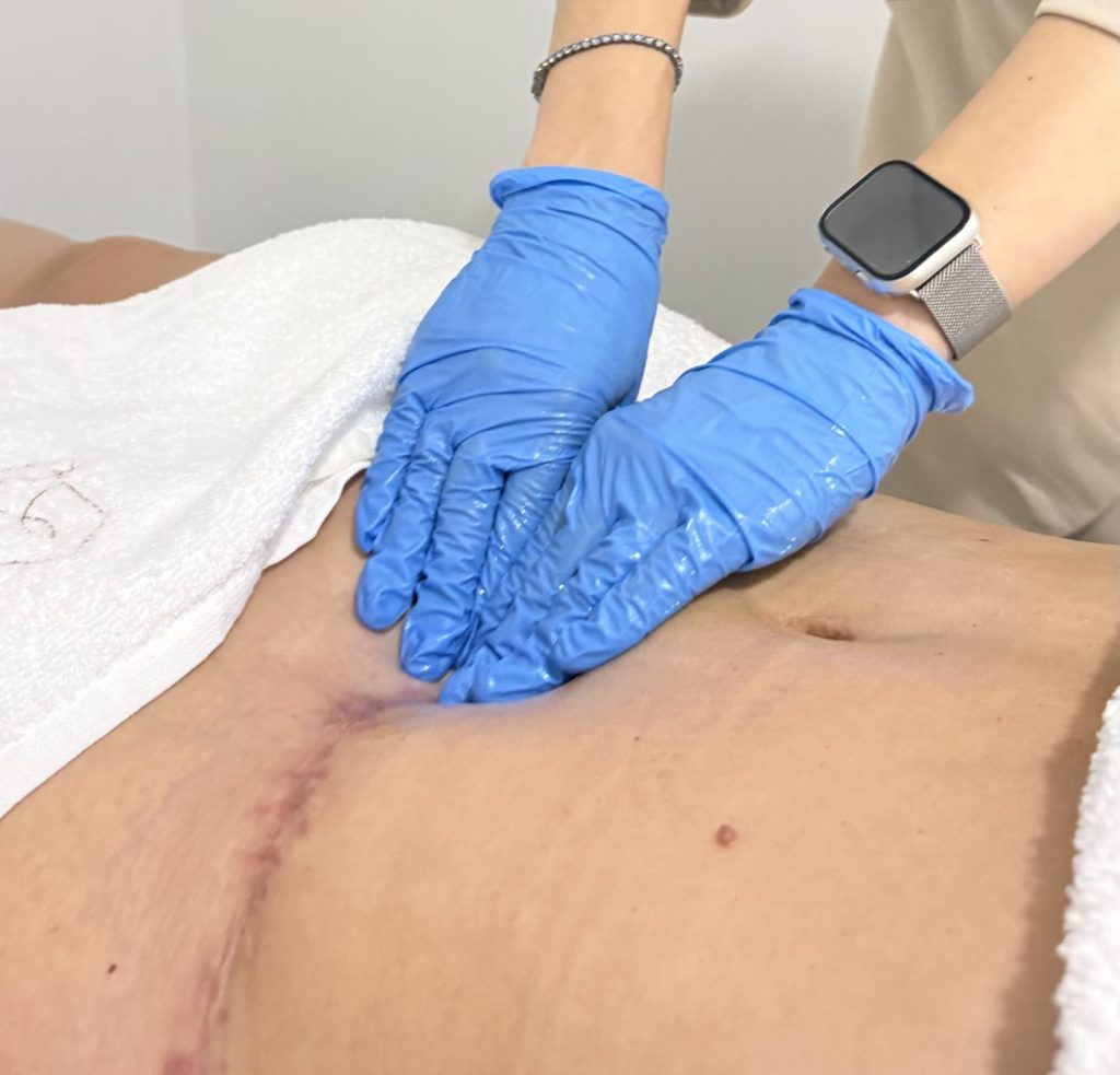 fibrose pos operatoria